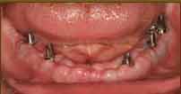 implant with abutments in place